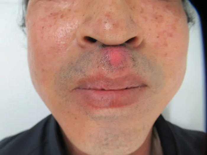 医師監修 鼻の中にもニキビができる？！できものが痛いときの対処法や原因まで解説ハダメディア by BIHADADO.TOKYO