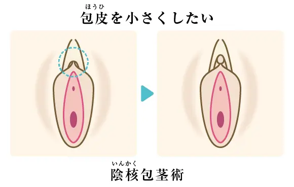 最新の小児包茎の治療方針-これでもうママも悩まない- －泌尿器科－｜KOMPAS