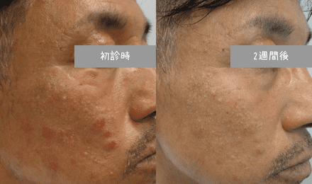 マラセチア毛包炎杉沢皮膚科クリニック