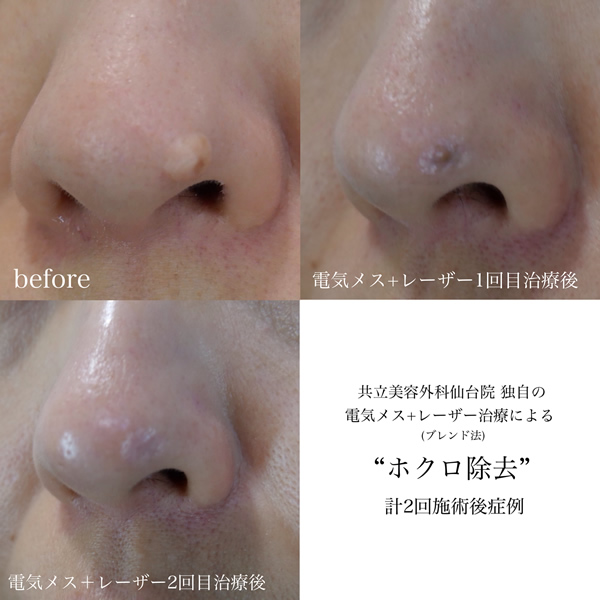 宝毛は幸運の毛栗原佑尽