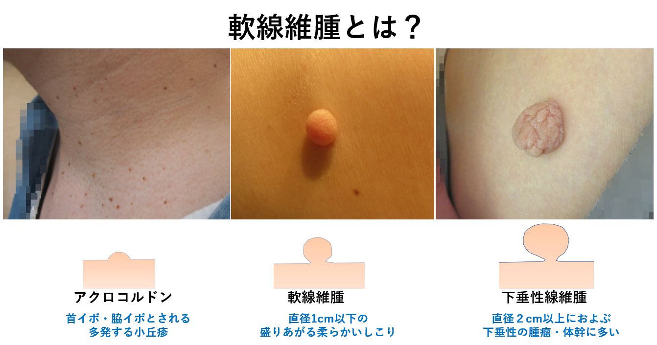 国立市のイボ治療、谷保駅前皮フ科イボ