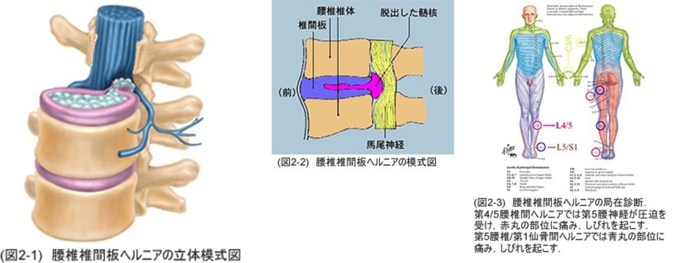 馬尾神経障害の主な症状再生医療脳梗塞・脊髄損傷の幹細胞治療ニューロテックメディカル
