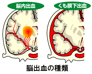 血液専門医が解説 アレルギー性紫斑病の症状・診断・治療