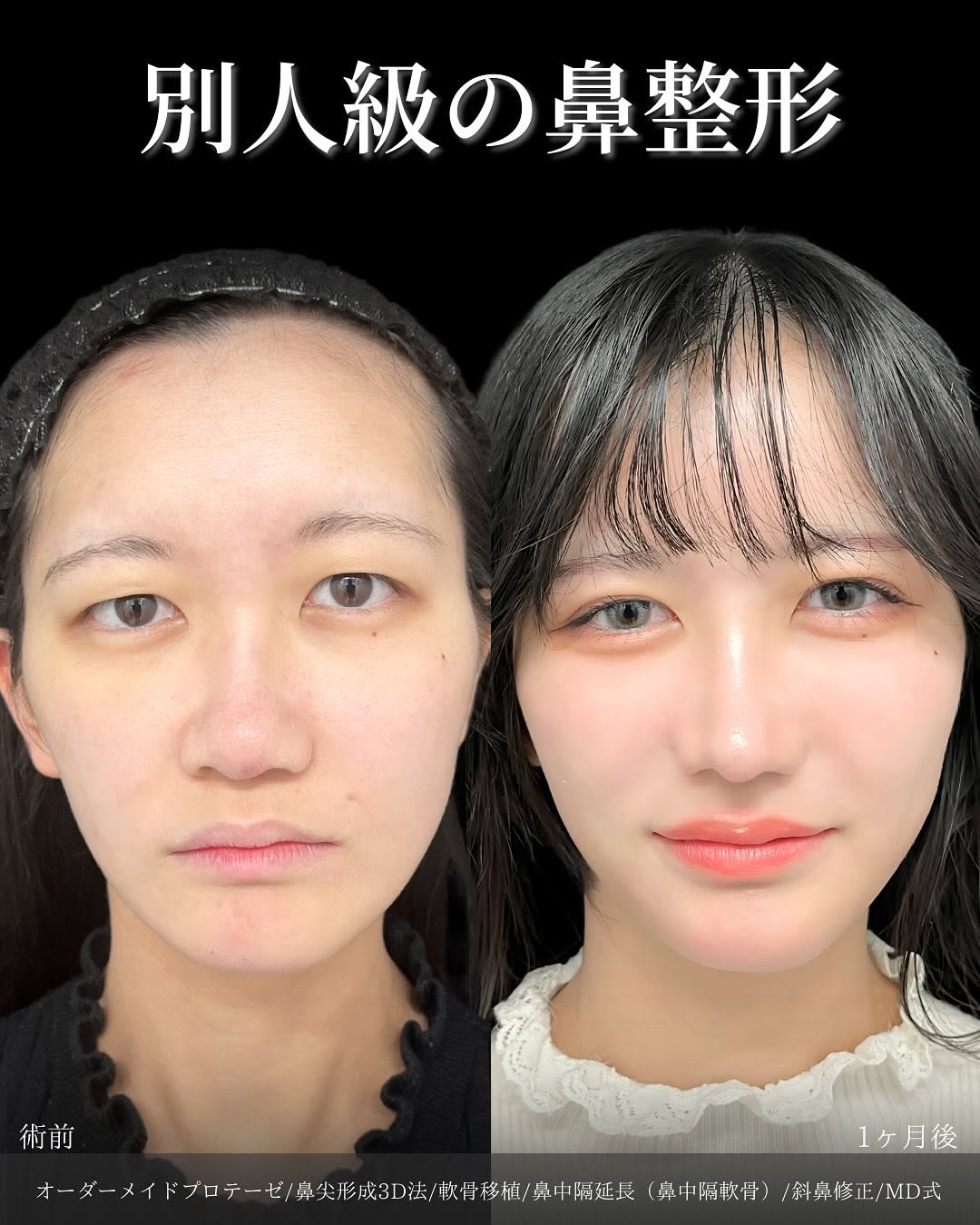 曲がった鼻・斜鼻の治療を、２ステップで”目で見て”理解するさいとう 齋藤 隆文 公式HP美容外科医 形成外科専門医