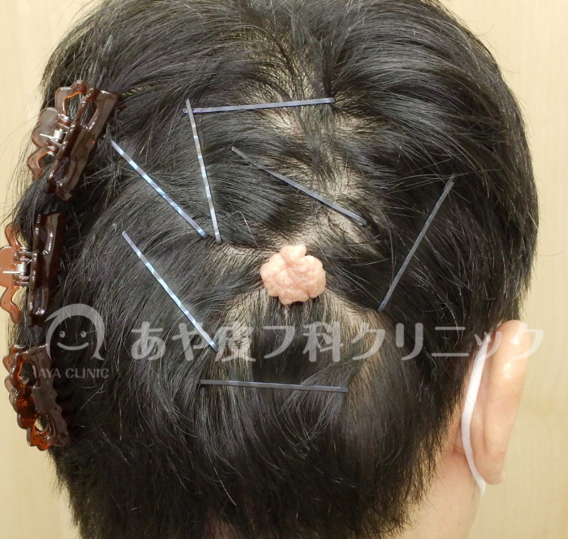 頭皮に吹き出物 - にきびのストックフォトや画像を多数ご用意 - にきび, 髪, 毛嚢炎 - iStock