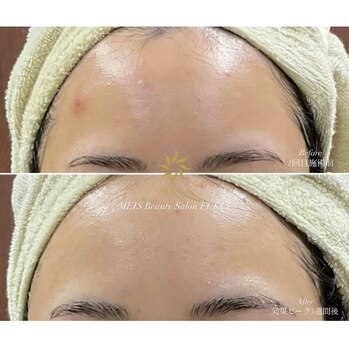 フォトフェイシャルの効果で施術直後からトーンUPを感じられます。 お肌内のコラーゲンが増殖＆ターンDione自由が丘山下有香子 Dione自由が丘所属 のエステ・リラクカタログ 20240412213702 ミニモ