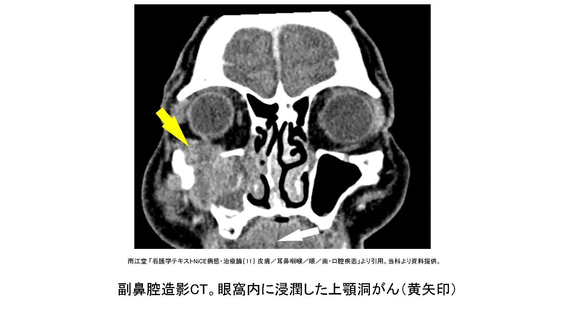 副鼻腔がん - 19. 耳、鼻、のどの病気 - MSDマニュアル家庭版