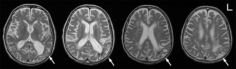 2024年版 下側頭回の機能とリハビリテーション：視覚認知と記憶の回復を目指して – STROKE LAB 東京 大阪 自費リハビリ脳卒中 神経系