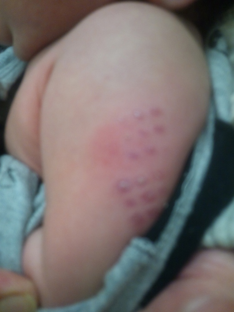 新型インフルエンザ予防接種後の症状について厚生労働省