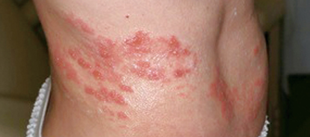 眼部帯状疱疹がんぶたいじょうほうしん とは済生会