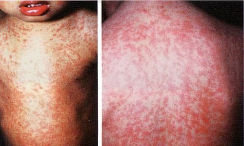 手足口病、兄弟間で100％うつるって本当？清宮ゆうか年子兄妹のママ・薬剤師