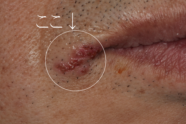 唇に白い斑点ができる原因は?受診目安や日常生活での注意点も解説！ – ココシカ