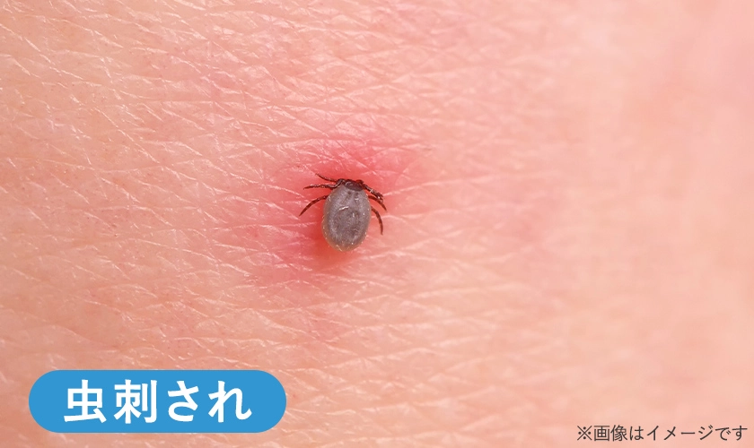 おしりのニキビ対策・予防におすすめ商品10選プロが試してレビュー！ドラッグストア マツキヨココカラオンラインストア