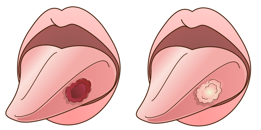 高齢者に特有な口腔疾患③ふじよし矯正歯科クリニック