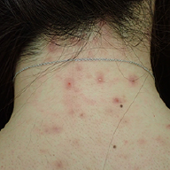 しこりニキビに悩む方必見！正しい治し方と間違った対処とは？ - 東京皮膚のできものと粉瘤クリニック ふるばやし形成外科 新宿院