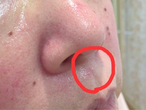 医療従事者監修 鼻の中のニキビの原因と治し方とは？ニキビが白い・痛いときの対処法を解説ニキビ、ニキビ跡、赤ら顔の改善なら渋谷美容外科クリニック