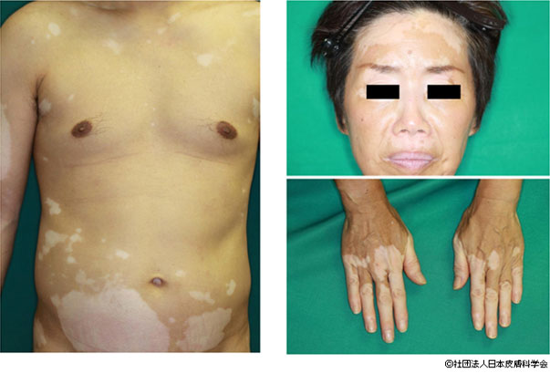 この皮膚病 はたけ 本当に目立ちますよね。オロナインを塗っても治- Yahoo!知恵袋