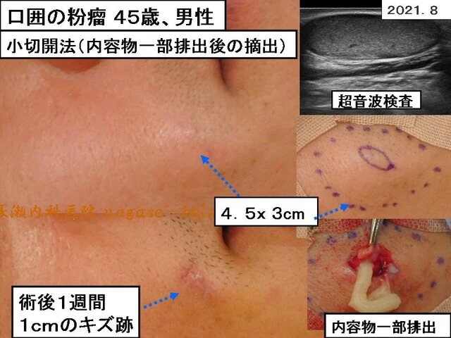 胸の粉瘤治療症例 33歳女性 S様あすなろクリニック