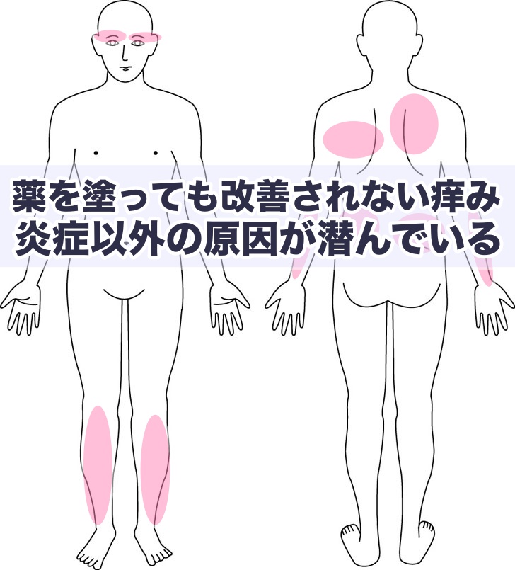 背中が乾燥する原因と症状肌トラブル予防のための対策 医師監修- メディプラス乾燥予防研究所