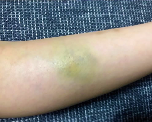 足の指をぶつけて痛い！内出血している！足の指の骨は折れやすい。放っておかずに早目に治療しましょう！ – すみだ整骨院直方,飯塚,田川,八幡で整骨院なら