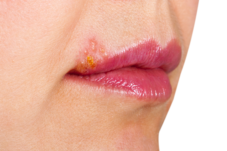 ヘルペス 単純ヘルペス 二子玉川駅徒歩3分月・火・木・金・土診療の皮膚科・美容皮膚科二子玉川皮ふ科