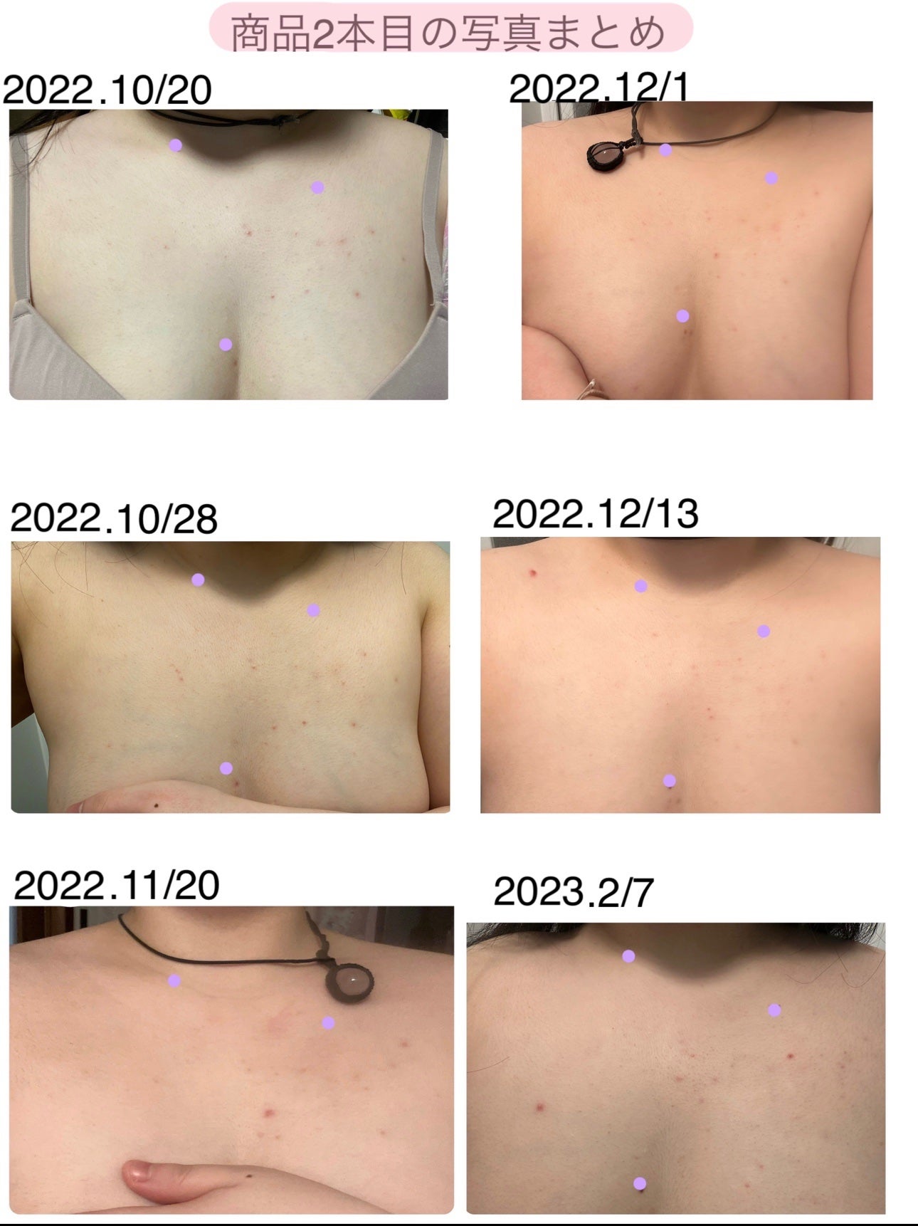 デコルテニキビの原因と予防法 跡を残さずキレイに治療するには？ -東京4院・大阪3院 美容皮膚科フェミークリニック