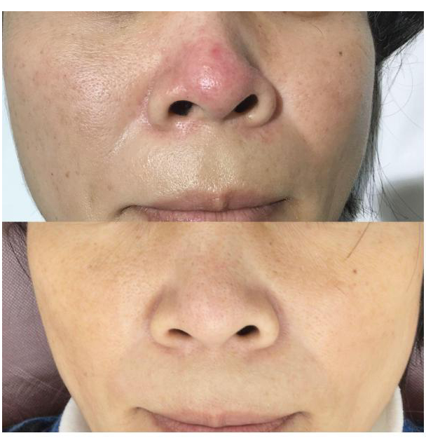 酒さってどんな病気？赤ら顔の原因や治療法を解説 - 池袋駅前のだ皮膚科