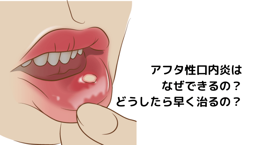 ケナログで口内炎を効果的に治す方法と注意しておくこと