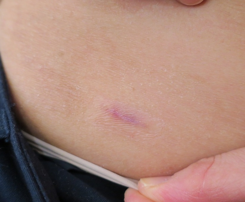 線維組織系腫瘍の手術を行うなら渋谷駅前おおしま皮膚科