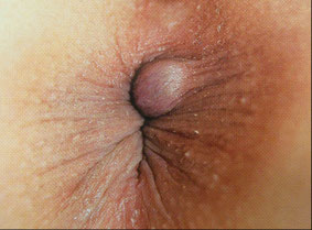 痔を悪化させる6大要因 痔の治療なら 東京青山 平田肛門科医院