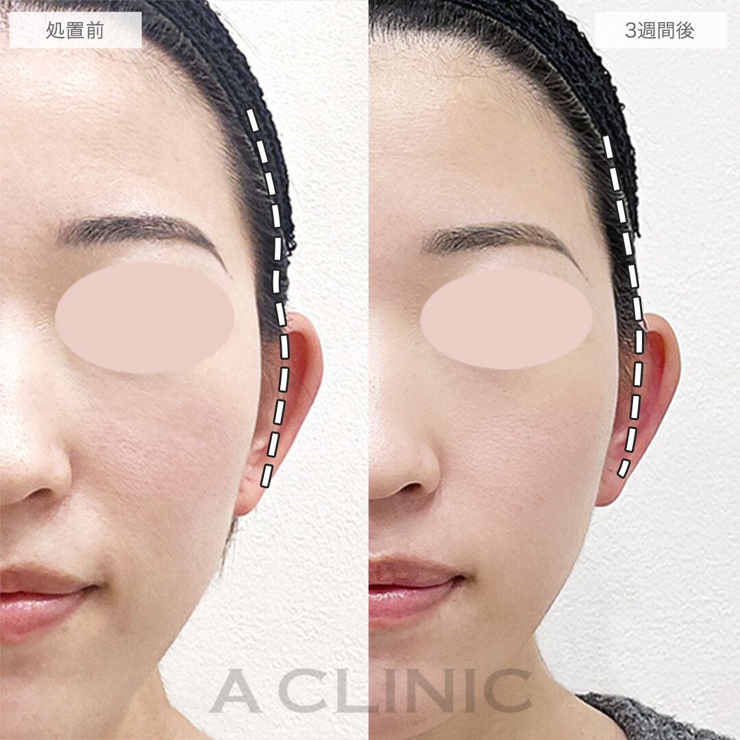 エラボトックス注入術美容整形なら大塚美容形成外科