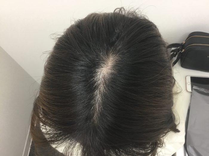 ミノキシジルの初期脱毛はなぜ起こる？症例画像もご紹介