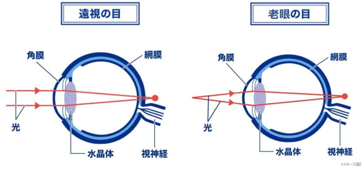 老眼 老視 の原因 症状・疾患ナビ健康サイト