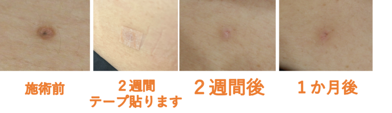首イボのできる原因は？皮膚科で取る3つの除去方法 - 東京・大阪の美容皮膚科ならFLALU フラルクリニック