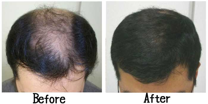 高校生つむじ横浜・首都圏の自毛植毛・植毛の専門医、ヨコ美クリニック