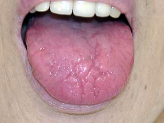 □審美歯科と舌 舌の色 ・粘膜疾患 – さいたま市岩槻区審美歯科のスワンデンタルクリニック