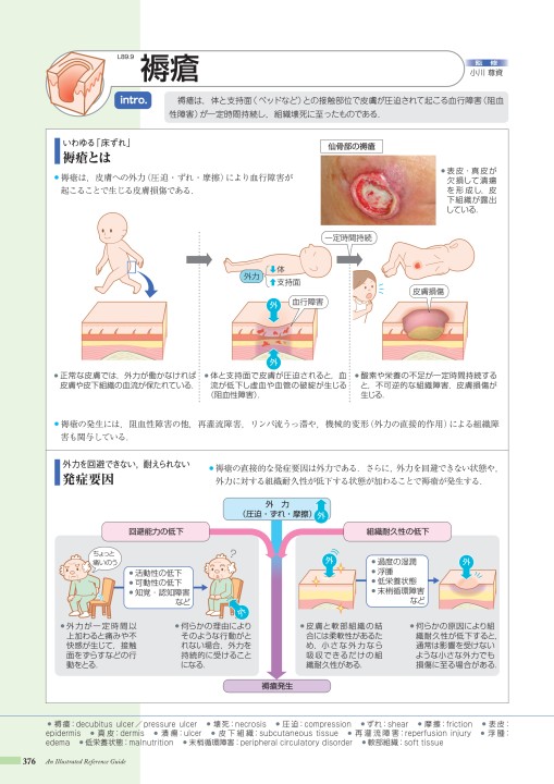 褥瘡 床ずれ の予防について
