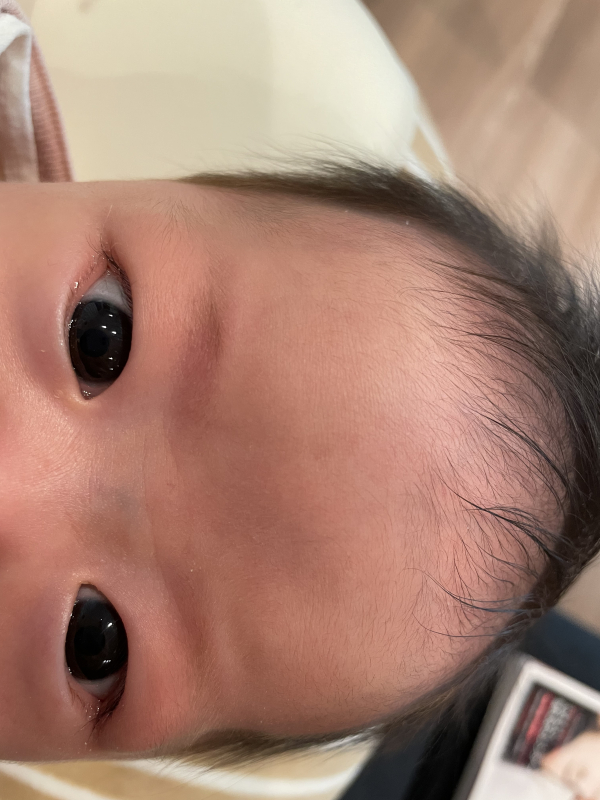 赤ちゃんが顔をぶつけたらできたあざはいつ消える？あざができる原因や程度の見方を徹底解説