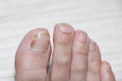 爪の病気 Q5 - 皮膚科Q＆A 公益社団法人日本皮膚科学会