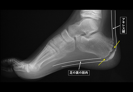 成長期のスポーツ外傷：子どもに起こりうる、足の骨折 骨端線損傷- 長崎市のはしぐち整骨院日曜営業・交通事故治療・足底筋膜炎
