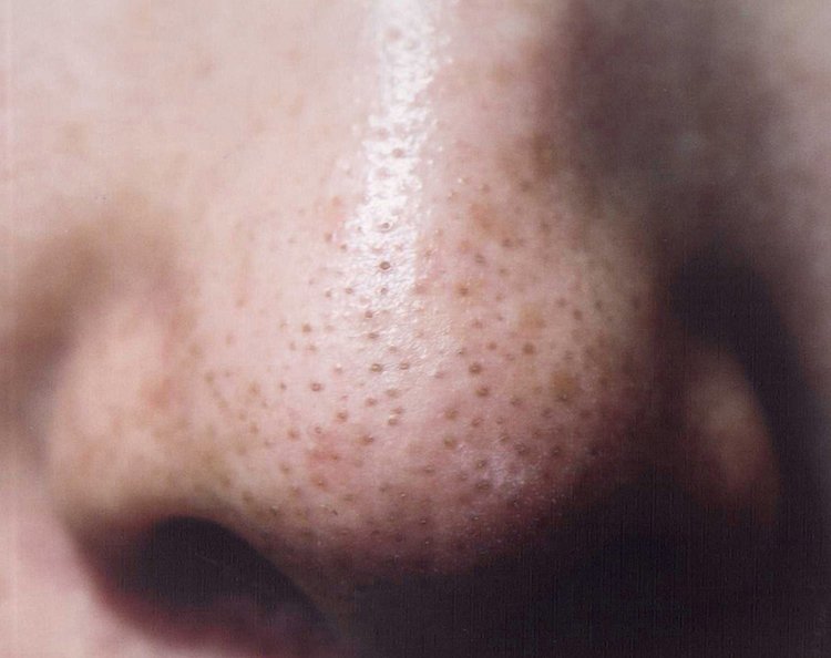 毛穴の白いニョロニョロの正体と取る正しい方法を解説！ANS. magazine