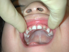 歯周病が親から子にうつるのは本当？みつはし歯科・矯正歯科 市原