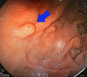 バリウム検査で異常と言われたらさいたま市浦和消化器内視鏡クリニック内視鏡検査・消化器内科