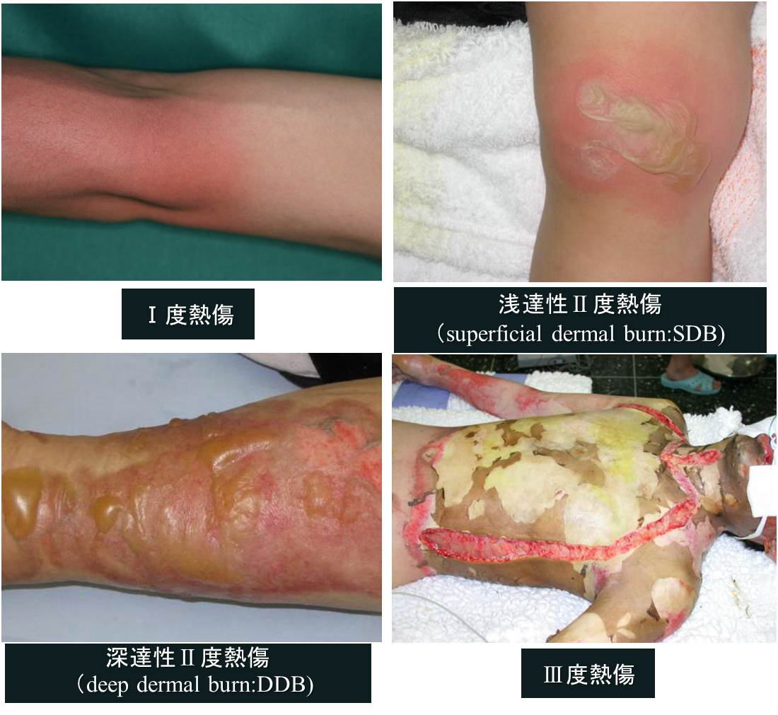 症例59：ふくらはぎのやけど 半年後の写真ありつかもと内科