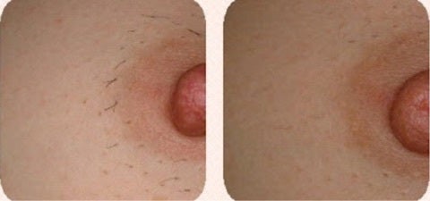 みんな実際どうしてるの!? バストのムダ毛実態調査 2021年最新版mismos ミスモス