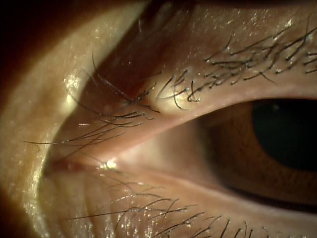 陰部 女性 のできもの・しこりの原因と検査、治療薬 画像あり 天神マイケアクリニック