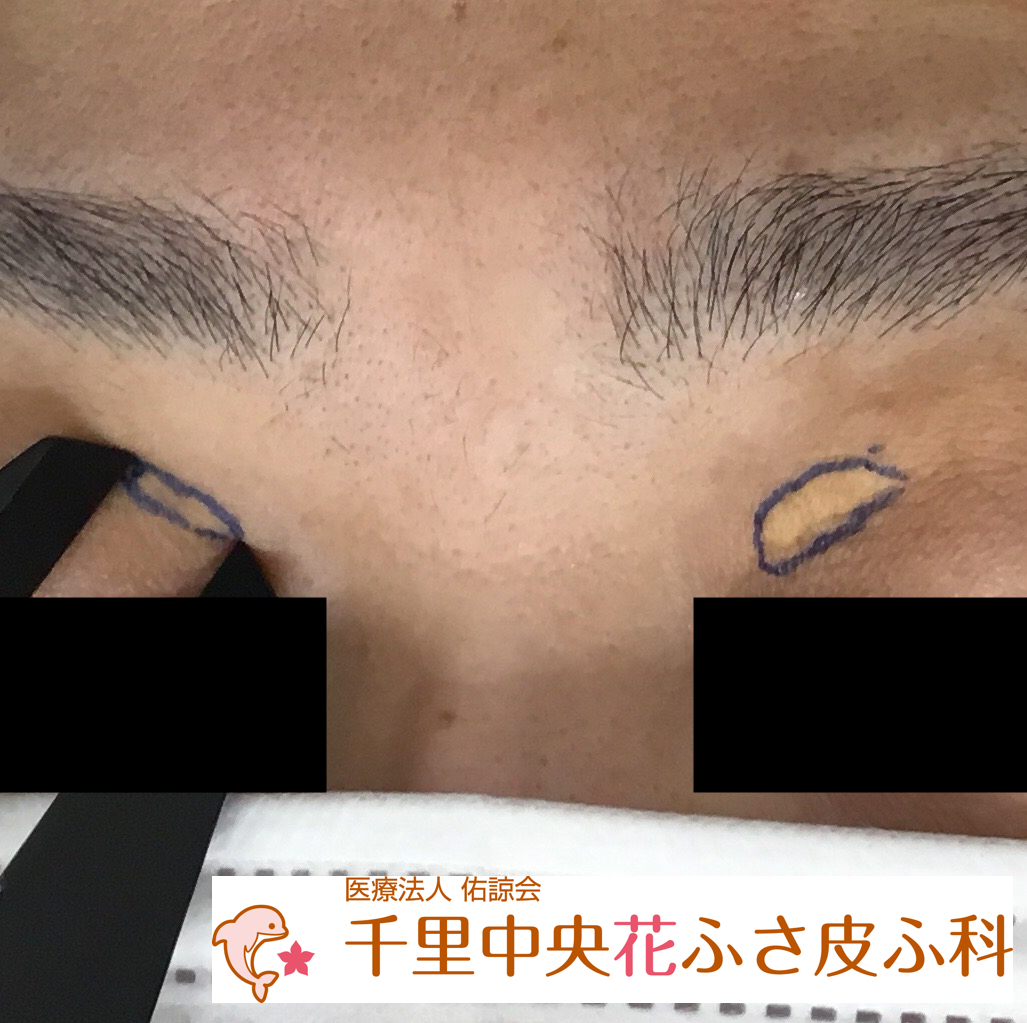 脂質異常症の初期症状とは？コレステロールが高いとどうなる？特徴を医師が徹底解説。 - オンライン診療ならウチカラクリニック