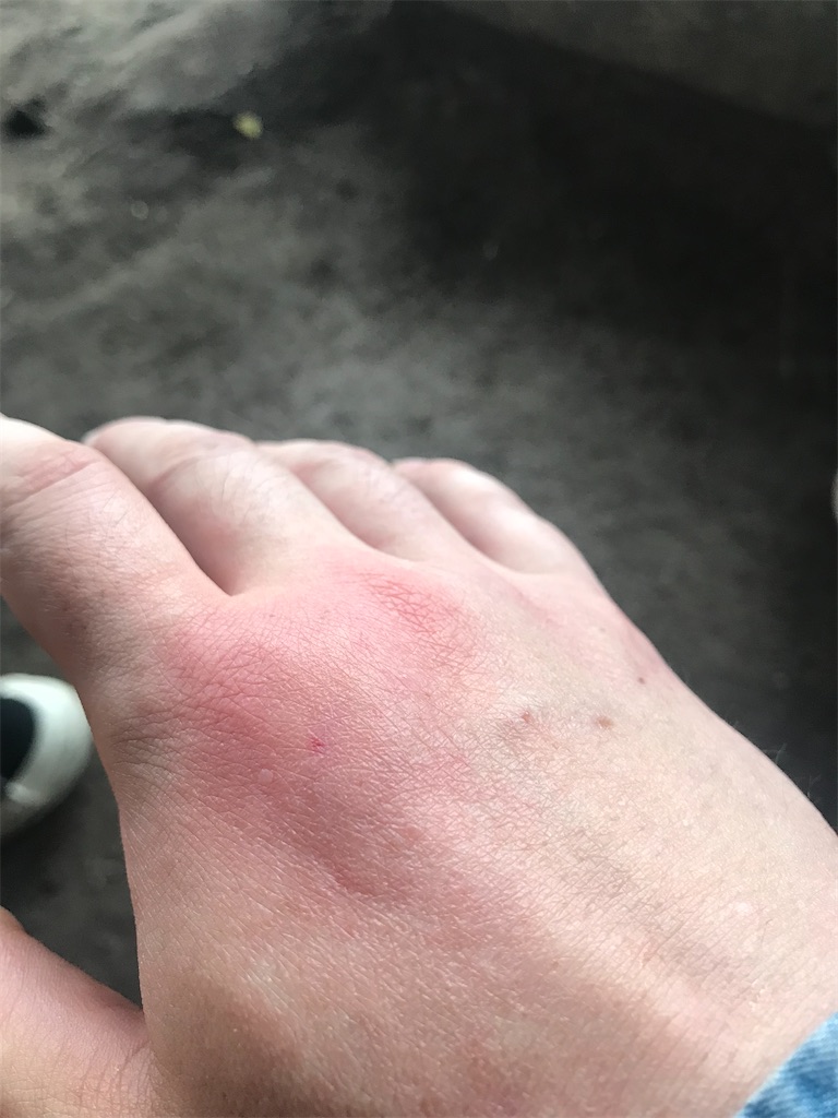 もし蜂に刺されたなら - 横浜・藤沢で植木の剪定・伐採・造園は梶山庭苑で