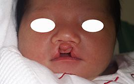 生まれてくる我が子に口唇裂が発覚→「現代の医療すごおおおい！」まさかここまで綺麗になるとは 感激の声まいどなニュース