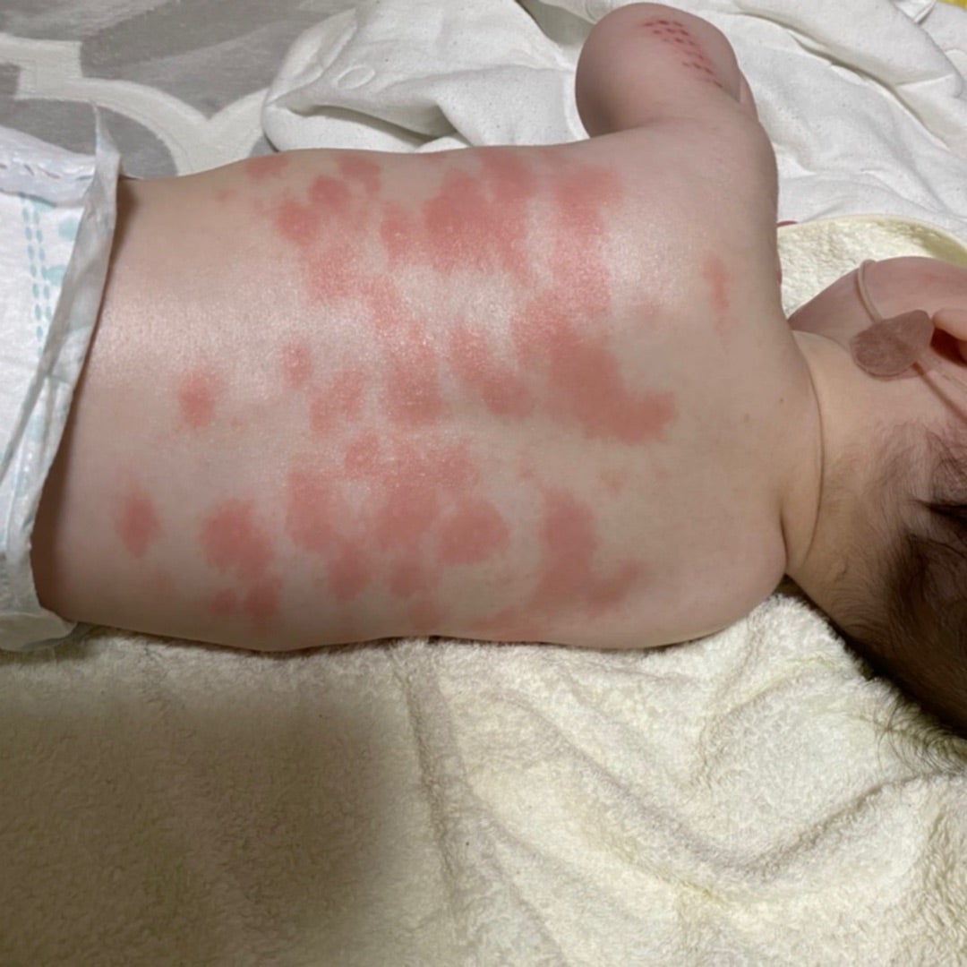 これって脂漏性湿疹？おうちでできるケアと受診の目安 - 小児科オンラインジャーナル